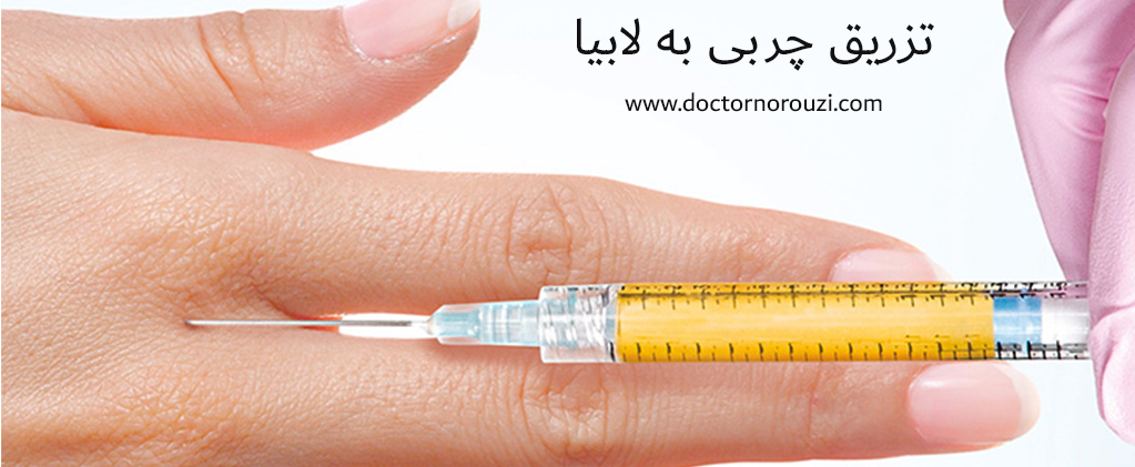 تزریق چربی به لابیا