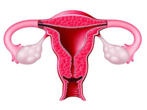 لاپاراسکوپی کیست های تخمدان