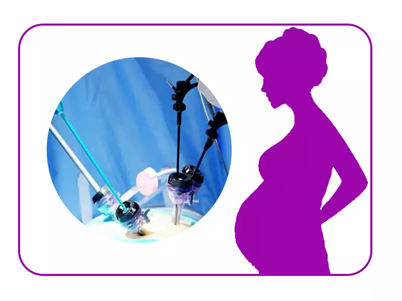 بارداری بعد از لاپاراسکوپی کیست تخمدان