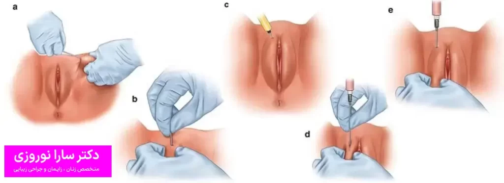 تزریق ژل به لابیا