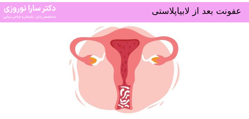عفونت بعد از لابیاپلاستی