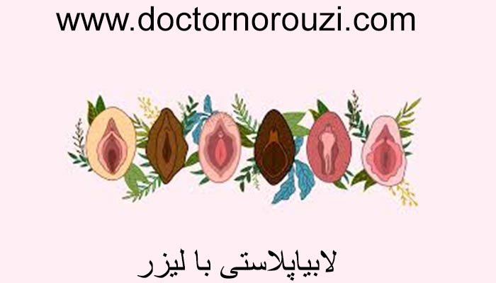 لیزر لابیاپلاستی
