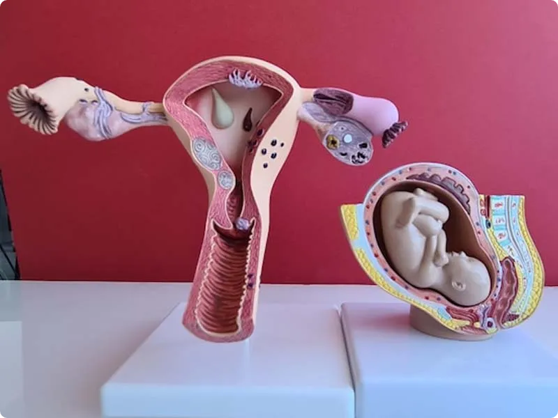 اندومتریوز در سزارین