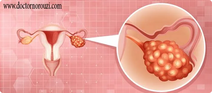 اندومتریوز در محل سزارین