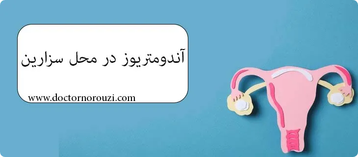 بیماری اندومتریوز در محل سزارین