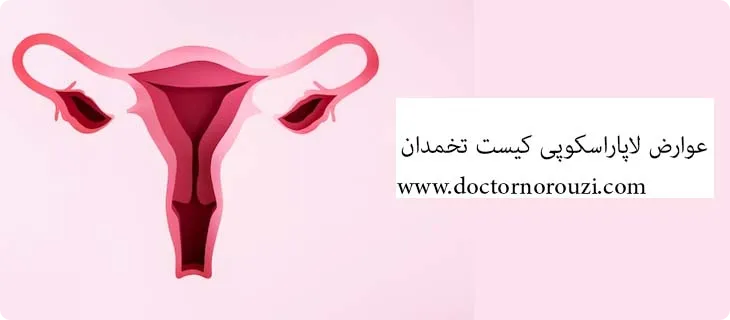 عوارض لاپاراسکوپی کیست تخمدان چیست