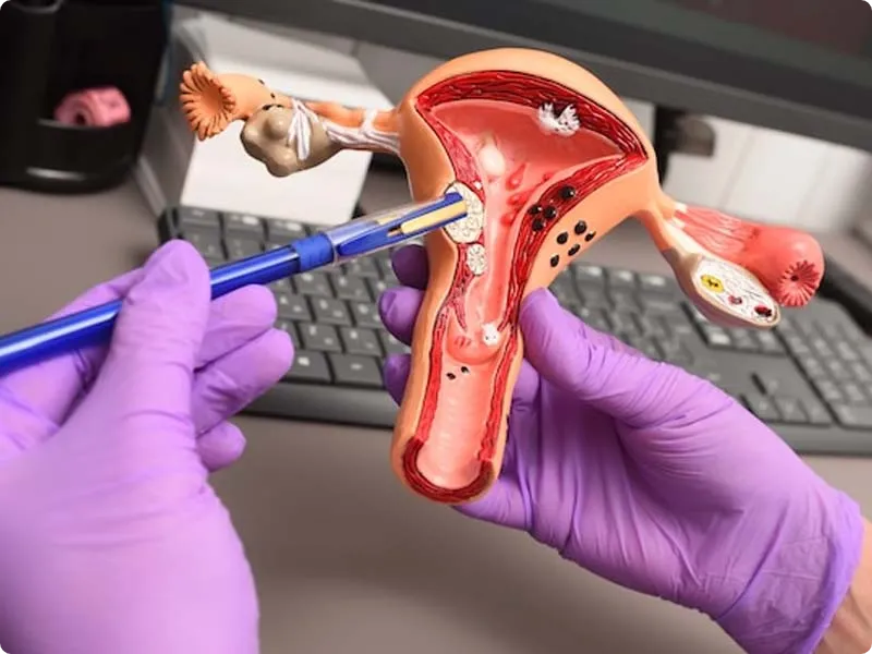 مراقبت های بعد از عمل لاپاراسکوپی کیست تخمدان