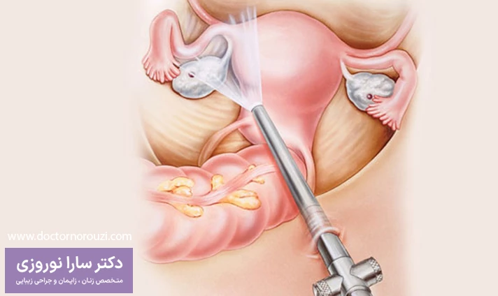 مزایای لاپاراسکوپی اندومتریوز