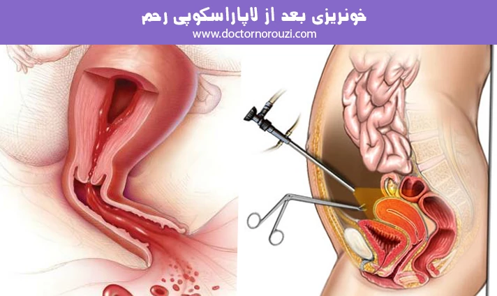 خونریزی بعد از لاپاراسکوپی رحم