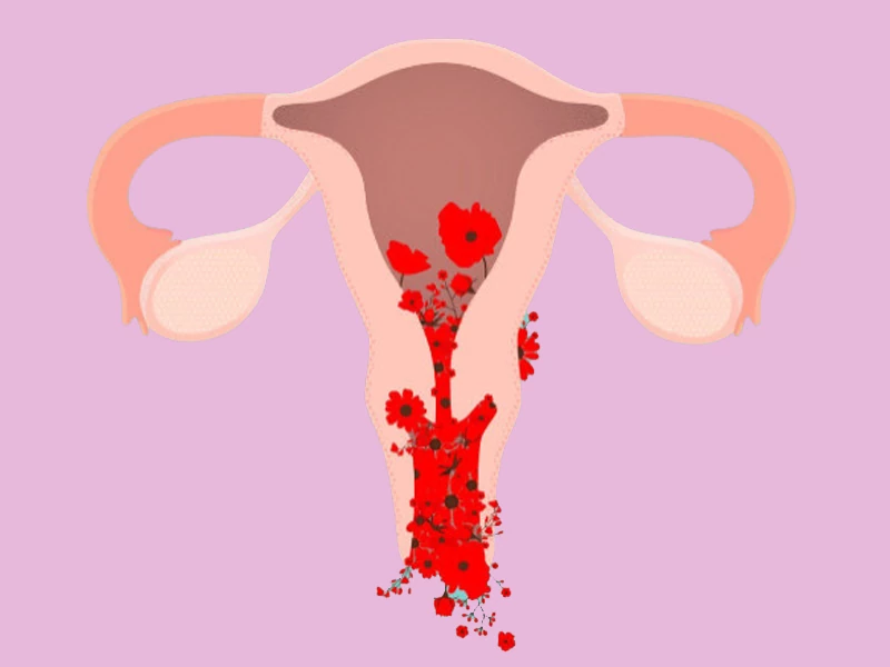 درمان خونریزی بعد از لاپاراسکوپی رحم