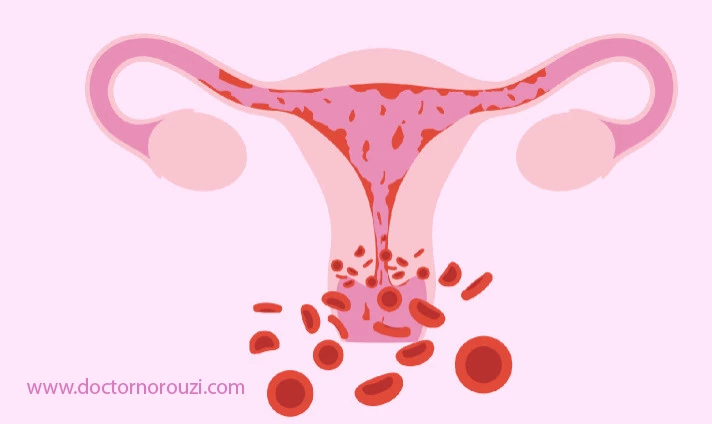 علت خونریزی بعد از لاپاراسکوپی رحم