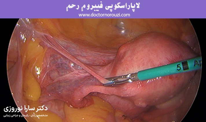 لاپاراسکوپی فیبروم رحم