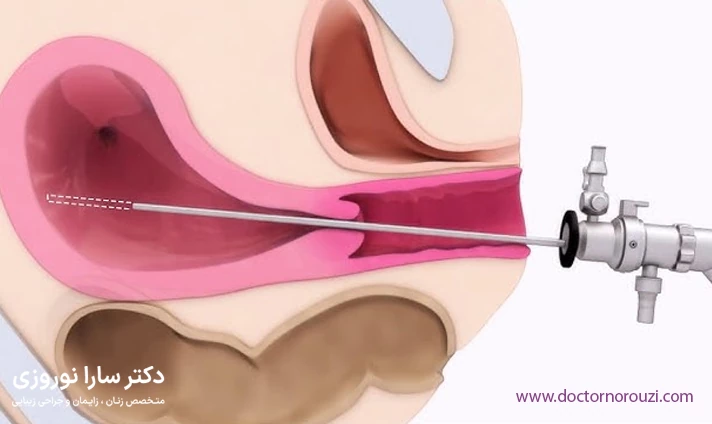 مراحل انجام لاپاراسکوپی فیبروم