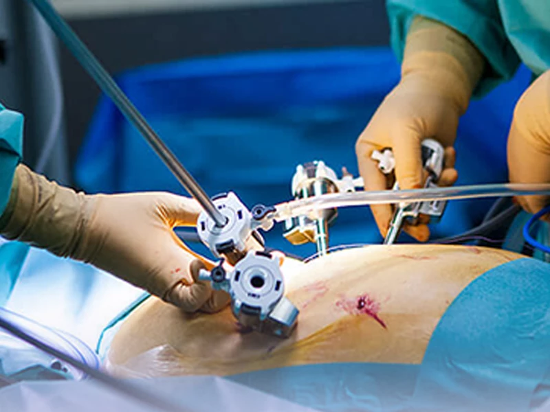 نحوه انجام هیسترکتومی لاپاراسکوپی