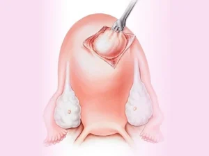 هزینه لاپاراسکوپی فیبروم رحم