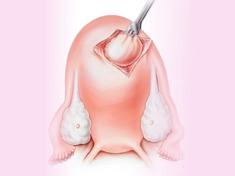 هزینه لاپاراسکوپی فیبروم رحم