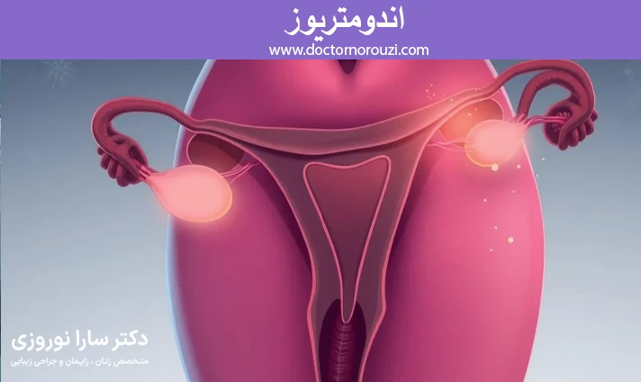 اندومتریوز