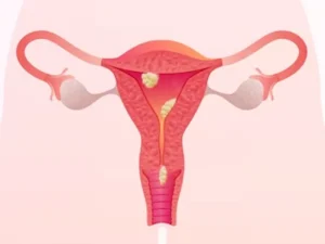 تشخیص پولیپ رحم