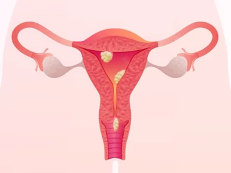 تشخیص پولیپ رحم