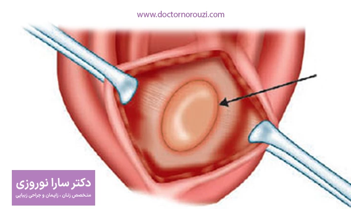 تشخیص کیست بارتولن