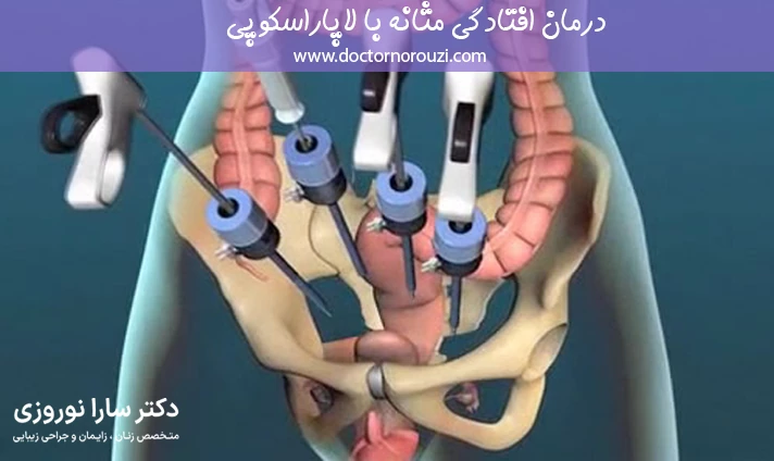 درمان افتادگی مثانه با لاپاراسکوپی