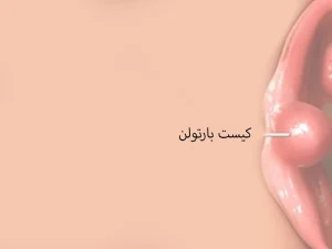 درمان کیست بارتولن