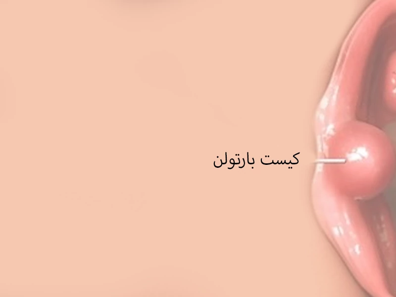 درمان کیست بارتولن