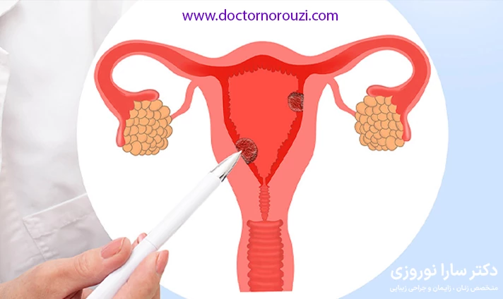 علائم پولیپ رحم