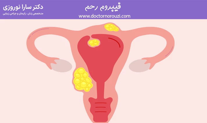 فیبروم رحمی