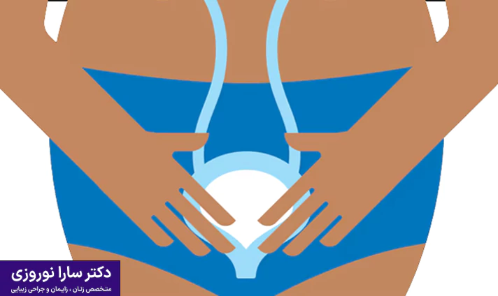 مراحل درمان لاپاراسکوپی افتادگی مثانه