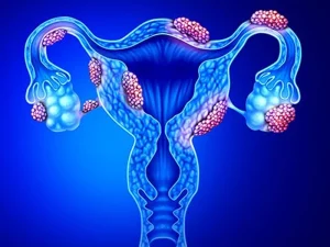 پیشگیری از فیبروم رحم