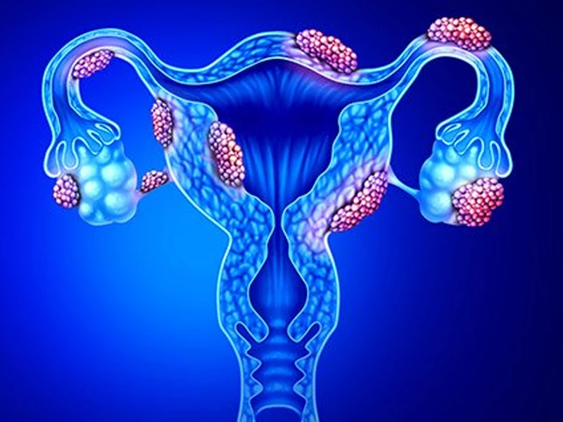 پیشگیری از فیبروم رحم