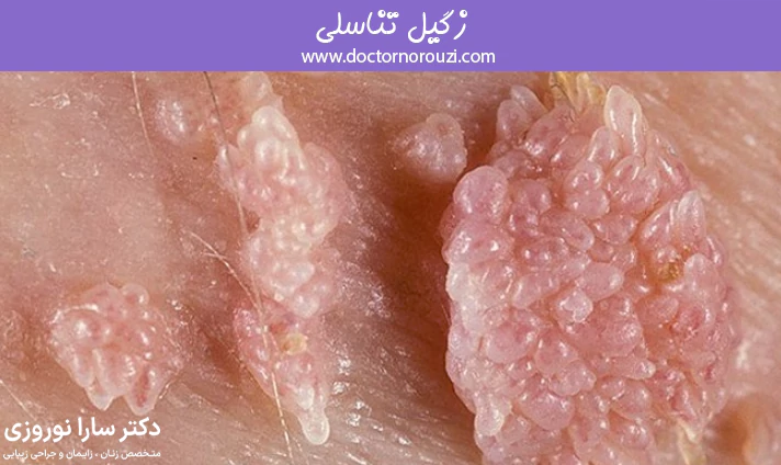 زگیل تناسلی