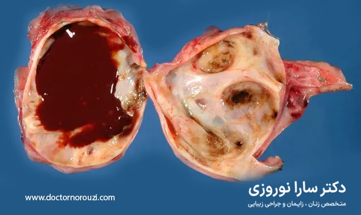 علائم ایجاد کیست شکلاتی