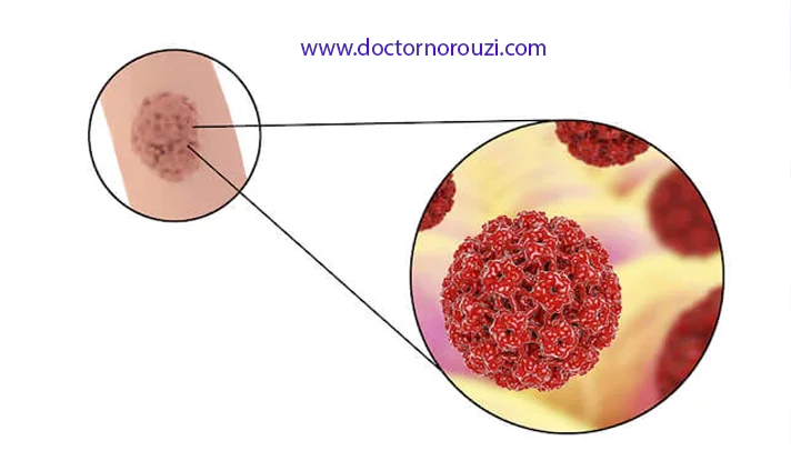 علائم زگیل تناسلی
