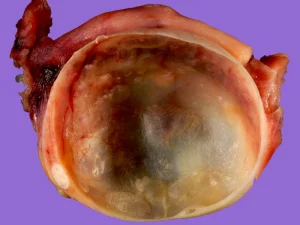 علت کیست شکلاتی