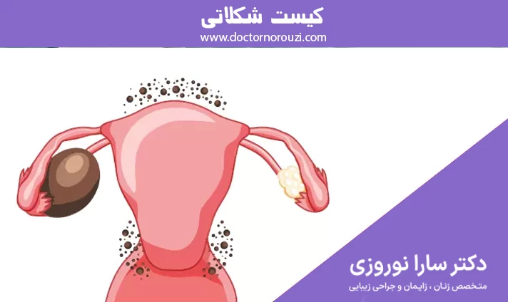 کیست شکلاتی