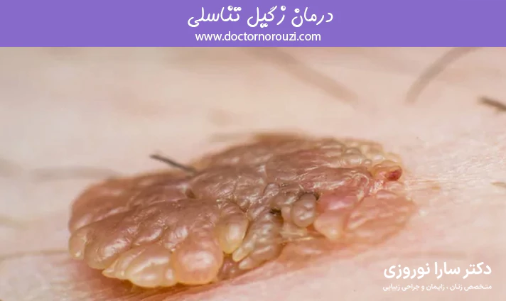 درمان زگیل تناسلی