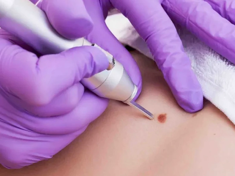 دکتر درمان زگیل تناسلی در تبریز