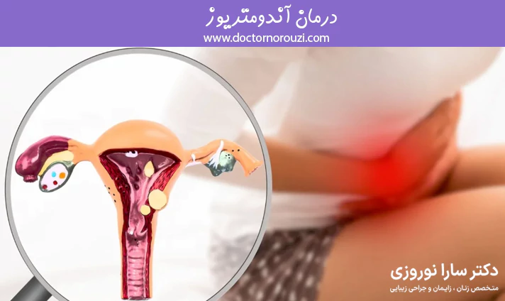 درمان آندومتریوز