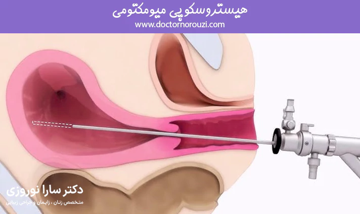 نحوه انجام هیستروسکوپی میومکتومی