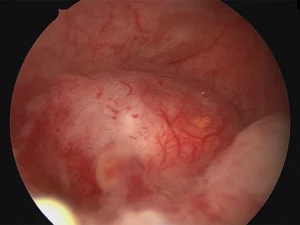 هیستروسکوپی میومکتومی