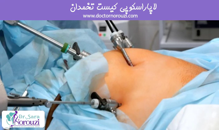 لاپاراسکوپی کیست تخمدان
