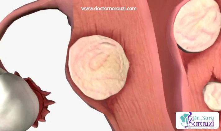 نحوه انجام لاپاراسکوپی کیست تخمدان