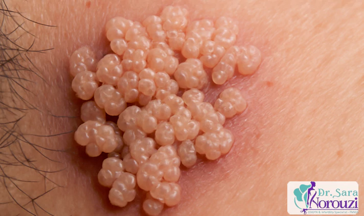 دلایل انجام کولپوسکوپی زگیل تناسلی