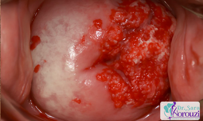 مهم ترین عوارض کولپوسکوپی