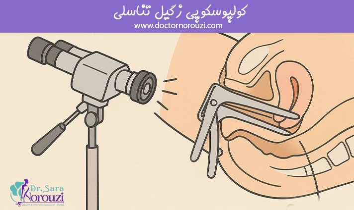 کولپوسکوپی زگیل تناسلی
