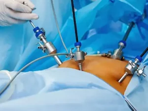 استراحت بعد از لاپاراسکوپی رحم